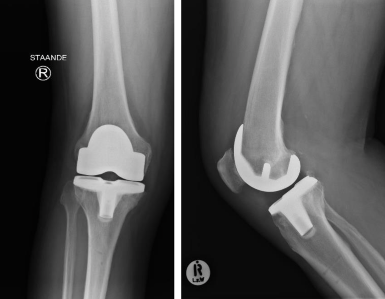 18 CPDs: Total Knee Arthroplasty Surgery & Rehabilitation for Biokineticists & CEPs